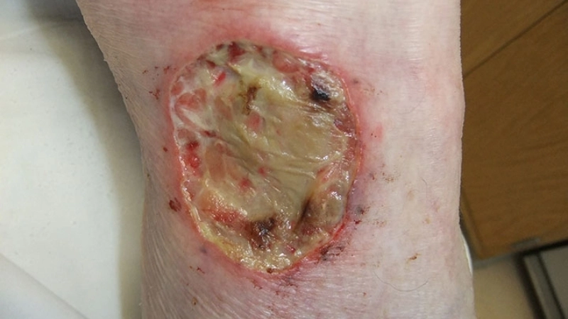 Biểu hiện hình ảnh viêm da cơ địa bội nhiễm có mủ