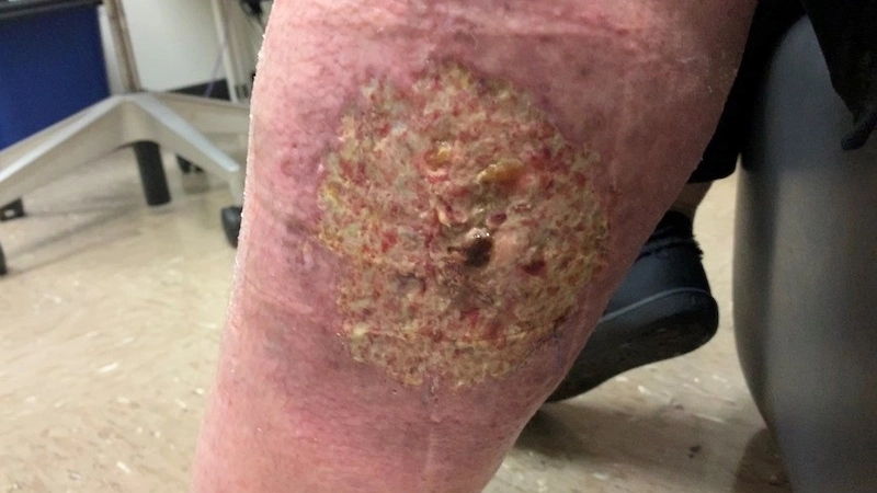 Phân biệt hình ảnh bệnh viêm da tiết bã và viêm da mủ