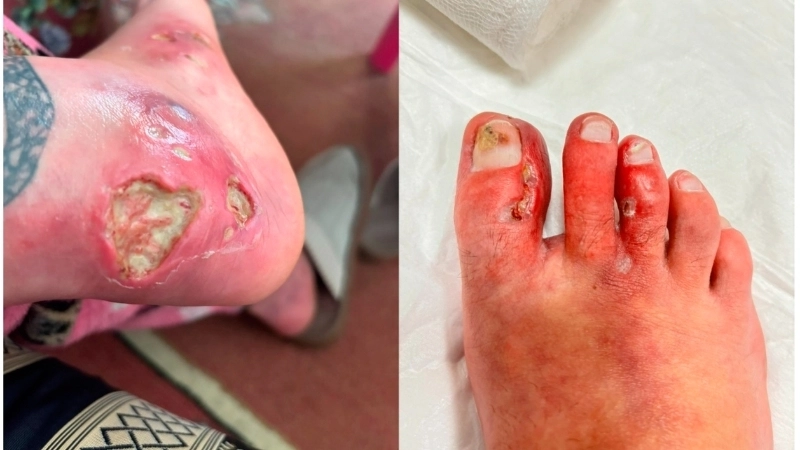 Biểu hiện qua hình ảnh viêm da cơ địa người lớn bị nhiễm trùng