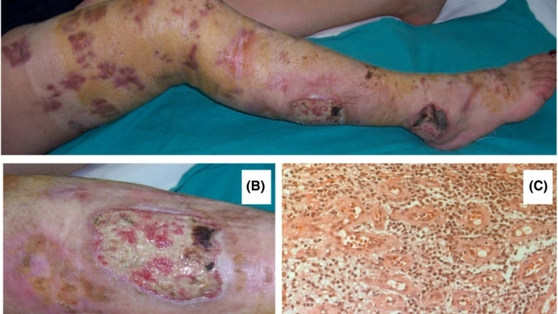 Các loại tổn thương trong hình ảnh viêm da tiếp xúc bội nhiễm