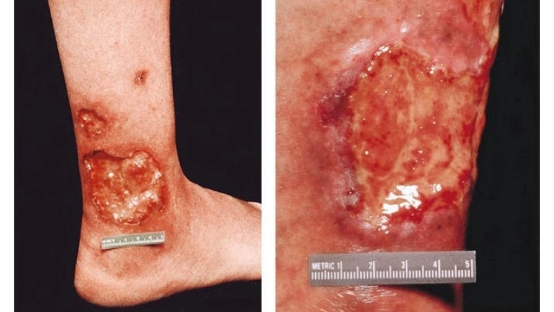 Tình trạng hình ảnh viêm da cơ địa ở tay xuất hiện mụn mủ