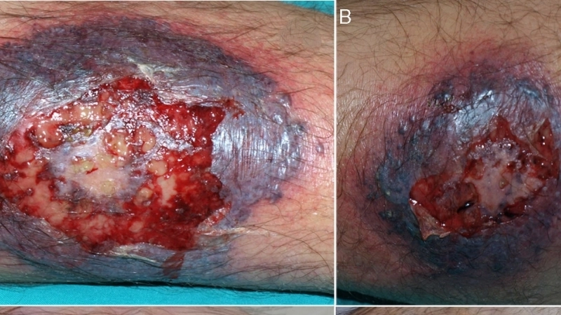 Cận cảnh hình ảnh bị viêm da do nhiễm trùng tụ cầu khuẩn