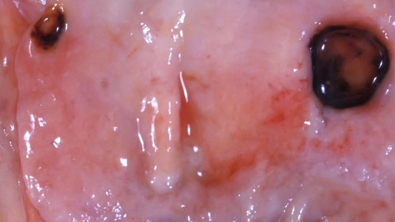 Một số loại thuốc trị viêm loét dạ dày được kê đơn phổ biến