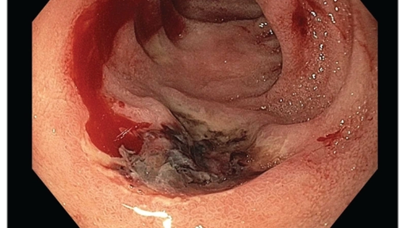 Hình ảnh vi khuẩn HP trong sinh thiết niêm mạc dạ dày