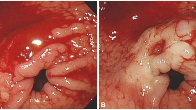 Dấu hiệu xuất huyết dạ dày qua hình ảnh ổ loét đang chảy máu