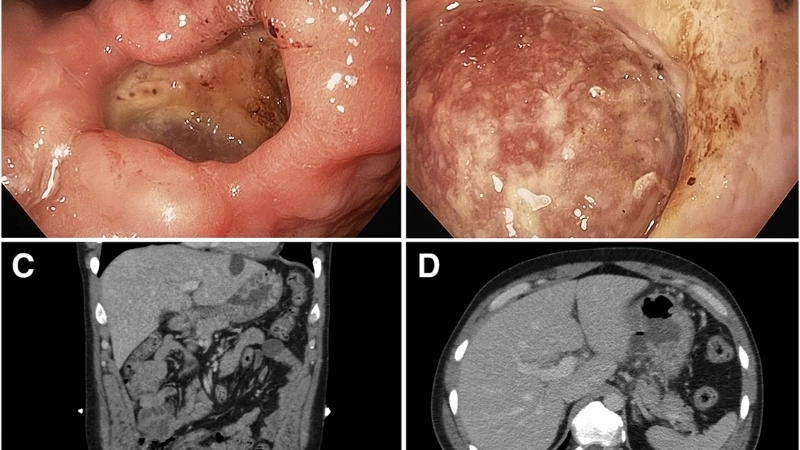 Phác đồ điều trị viêm loét dạ dày có vi khuẩn HP dương tính
