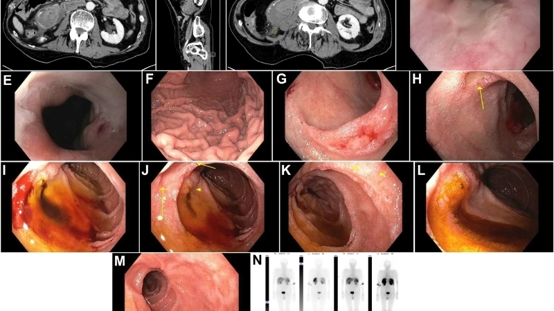 Biến chứng thủng ổ loét, một cấp cứu của xuất huyết dạ dày