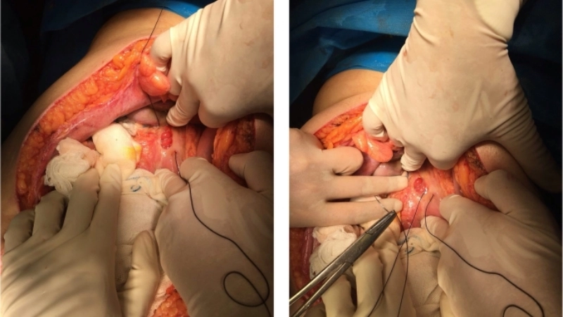 Quá trình liền sẹo của ổ loét sau khi điều trị viêm loét dạ dày thành công