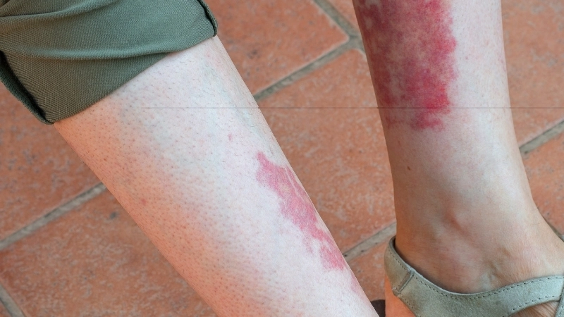 Sơ đồ giải thích nguyên nhân viêm mao mạch dị ứng do phản ứng miễn dịch