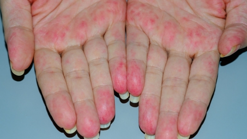 Phác đồ về cách điều trị viêm mao mạch dị ứng tại bệnh viện