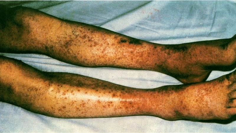 Hình ảnh viêm mao mạch dị ứng ở trẻ em tại cẳng chân