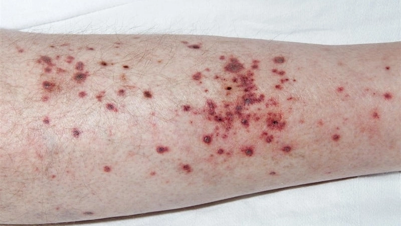 Ban xuất huyết dạng sẩn có thể sờ thấy được