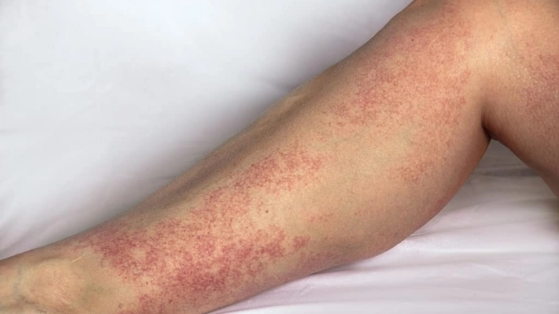 Tổn thương da ở mông và đùi trong giai đoạn cấp tính