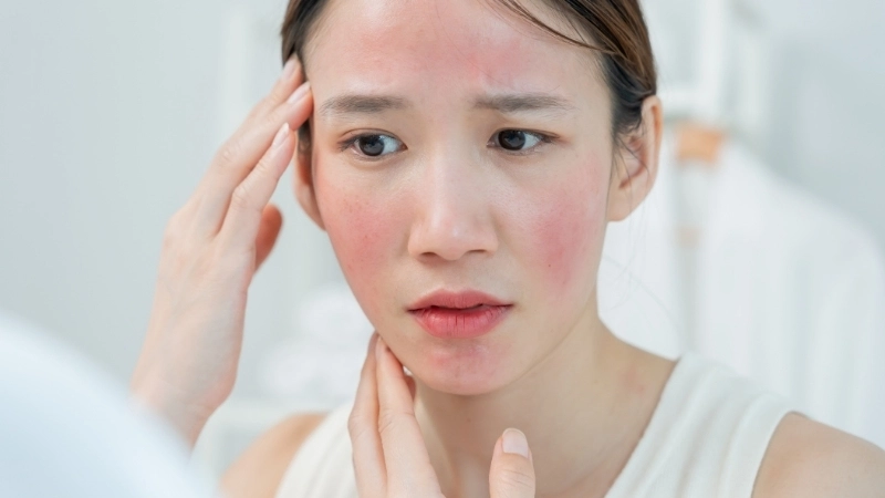 Hình ảnh ban xuất huyết đặc trưng của bệnh Henoch-Schönlein, thường đối xứng ở cẳng chân và mông.