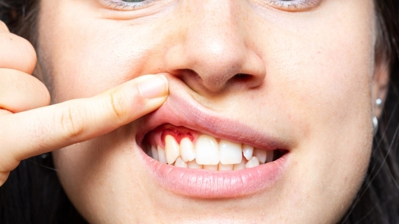 Minh họa nguyên nhân gây viêm nướu chính