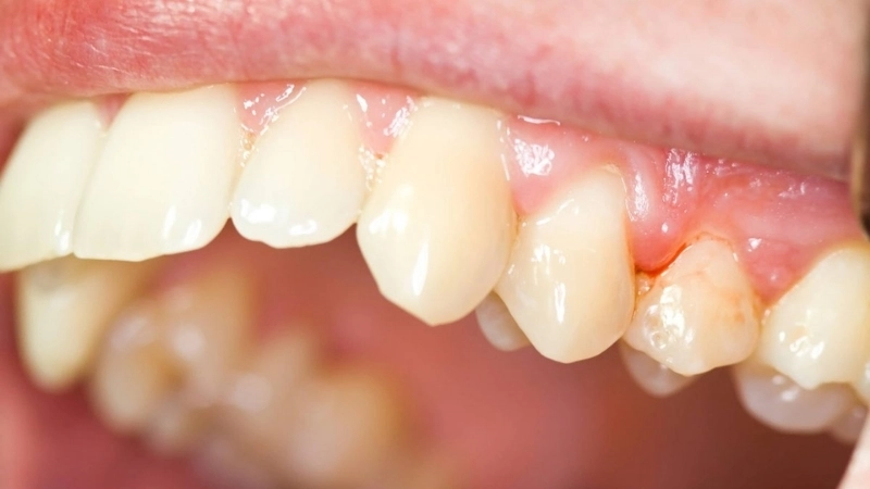 Chảy máu chân răng do viêm nướu