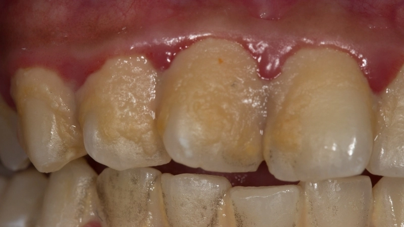 Một trong những nguyên nhân gây viêm nướu là do mảng bám tích tụ.