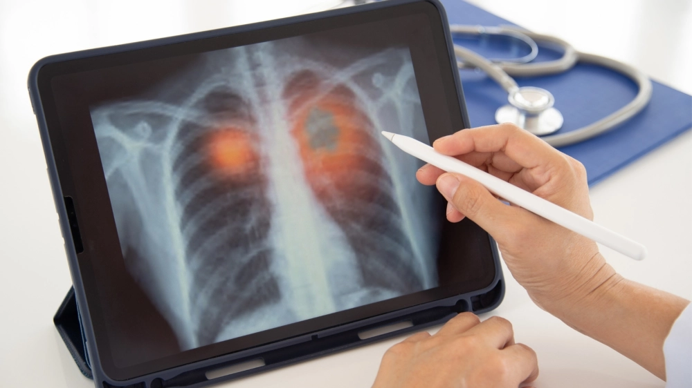 Giải đáp thắc mắc viêm phổi có lây không