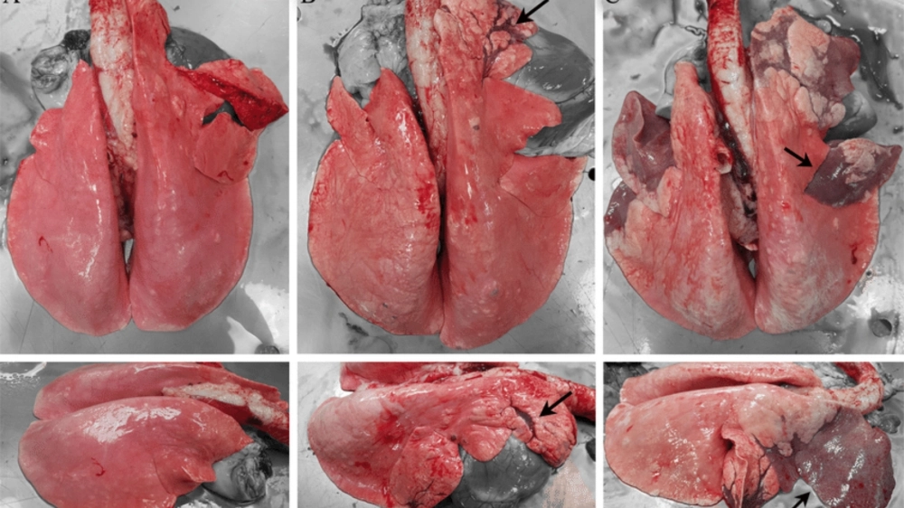 Phân biệt viêm phế quản và viêm phổi qua triệu chứng