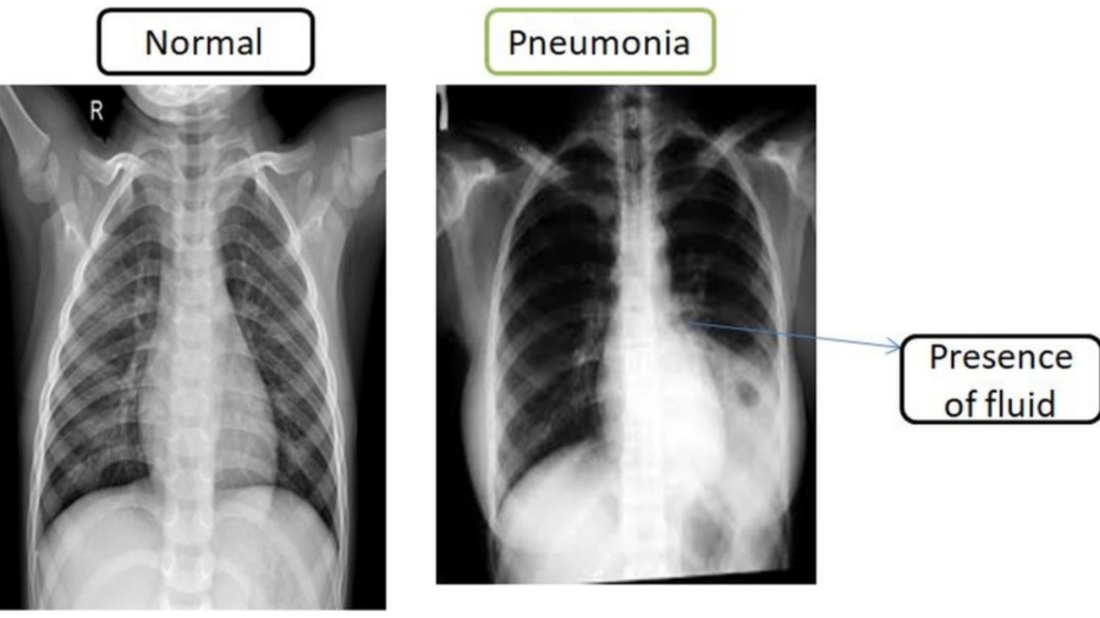 Hình ảnh tổn thương thùy phổi khi chụp X-quang phổi