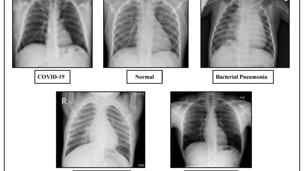 So sánh triệu chứng viêm phổi ở người lớn và trẻ em