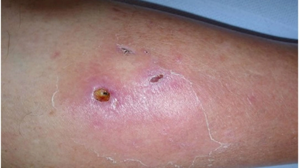 Các triệu chứng bệnh Whitmore không nên bỏ qua