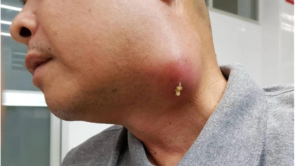 Vi khuẩn Burkholderia pseudomallei và con đường lây nhiễm