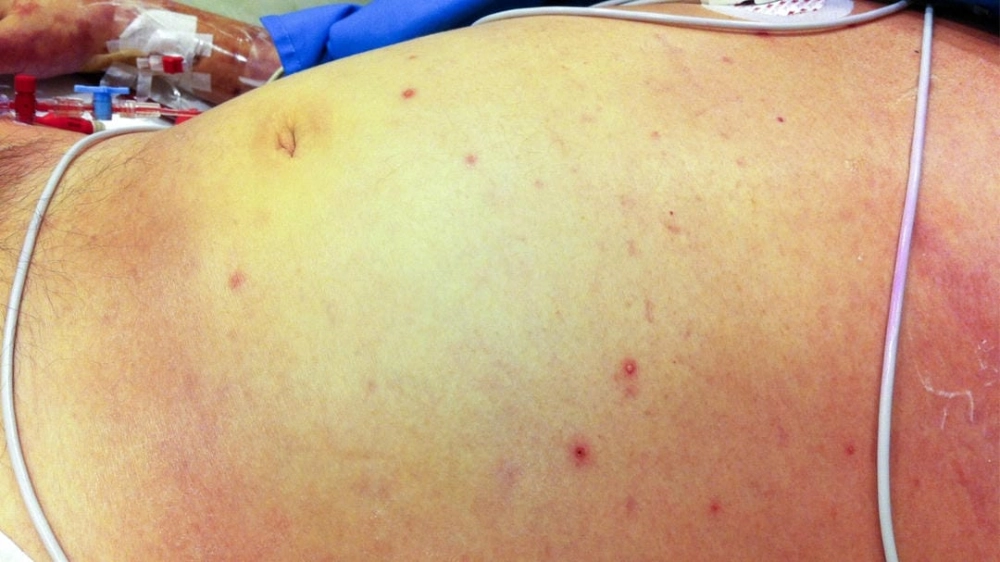 Thông tin y khoa về việc bệnh Whitmore có lây không