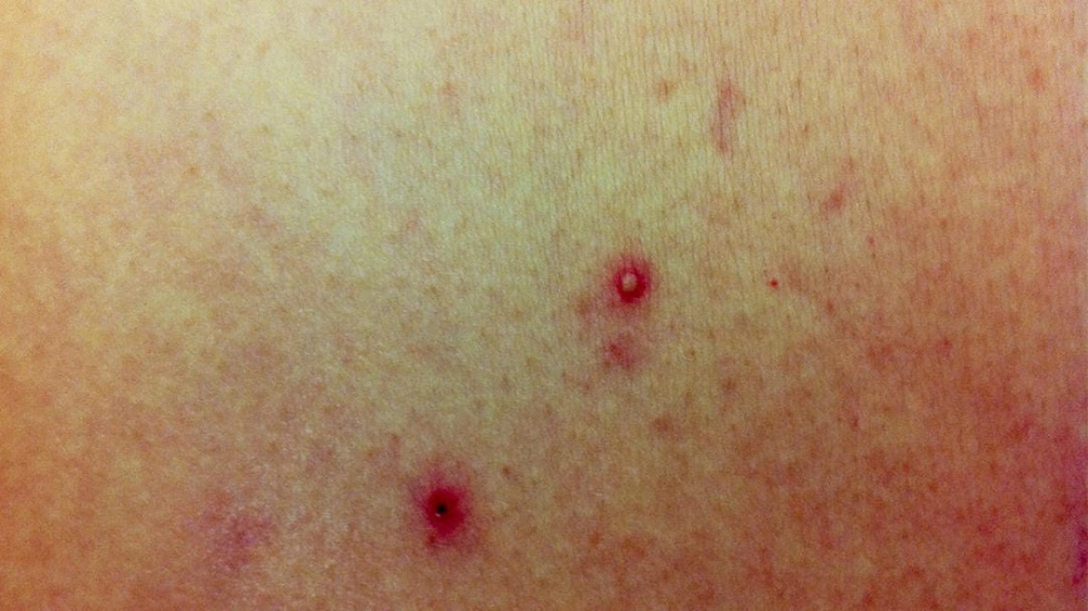 Các dấu hiệu nhiễm trùng máu do bệnh Whitmore