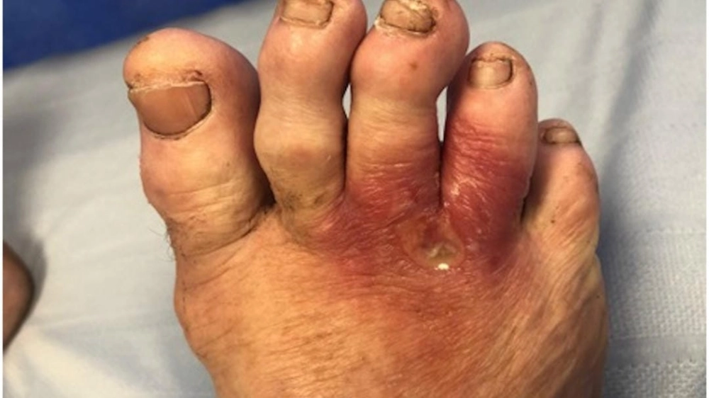 Tầm quan trọng của việc chẩn đoán sớm vi khuẩn ăn thịt người