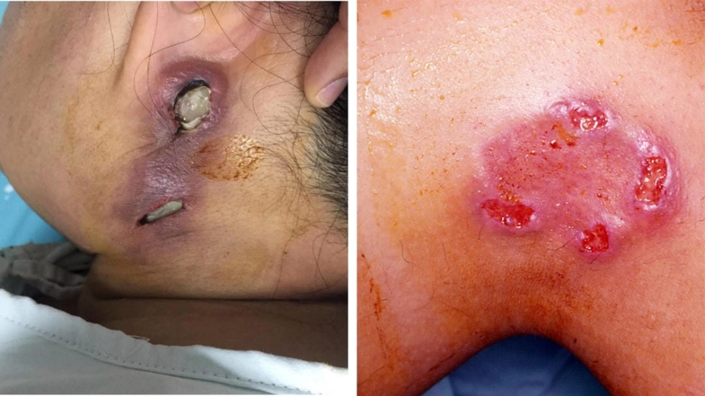 Phác đồ và cách điều trị bệnh Whitmore