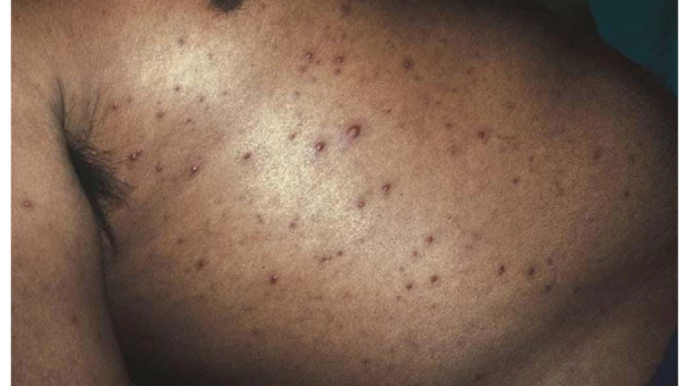 Hình ảnh tổn thương da do vi khuẩn ăn thịt người Whitmore