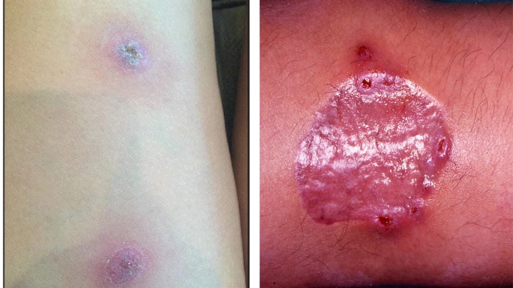 Hình ảnh áp xe phổi do vi khuẩn Whitmore