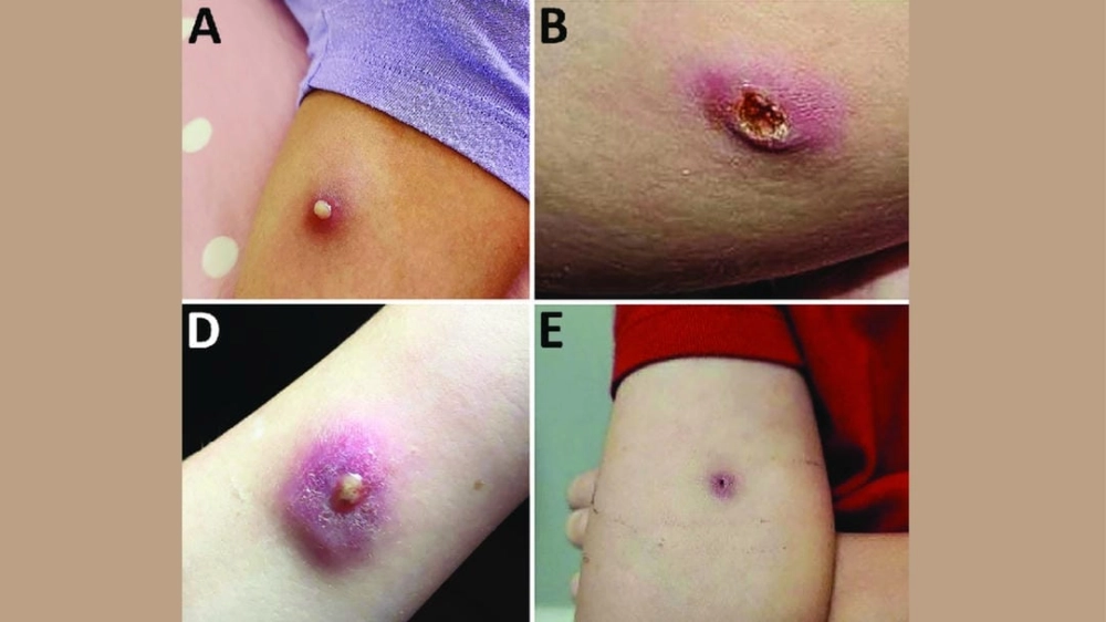Hình ảnh vi khuẩn Burkholderia pseudomallei dưới kính hiển vi, tác nhân chính gây bệnh Whitmore.