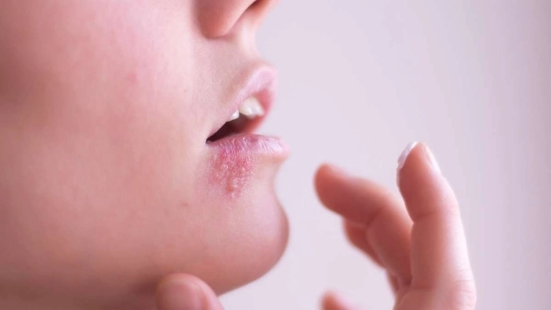 Minh họa cách chữa zona ở môi hiệu quả