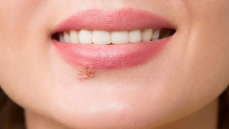 Các loại thuốc bôi zona ở môi được chỉ định