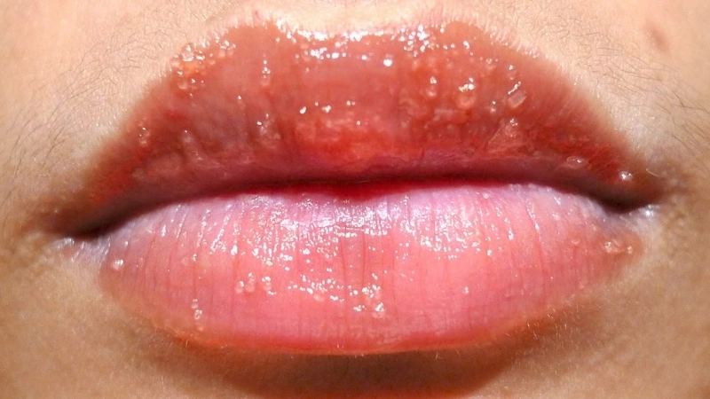 Các triệu chứng zona ở môi điển hình
