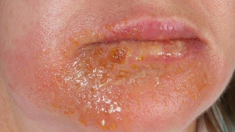 Hình ảnh bệnh giời leo ở môi và cách nhận biết