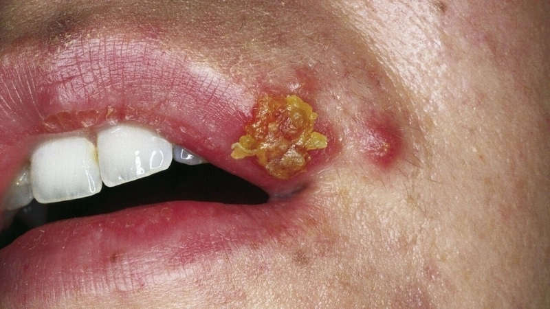 Dấu hiệu bệnh zona ở môi qua từng giai đoạn