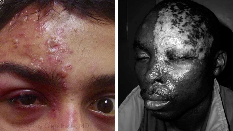 Triệu chứng zona thần kinh ở mắt trong giai đoạn khởi phát