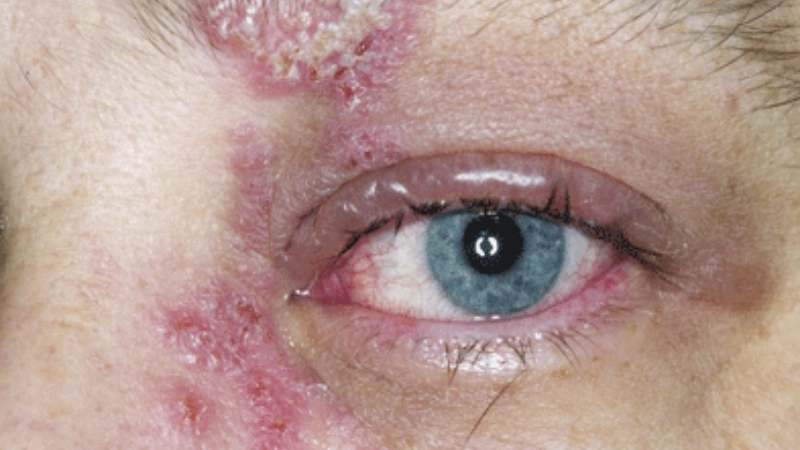 Quá trình hồi phục sau khi điều trị zona thần kinh ở mắt