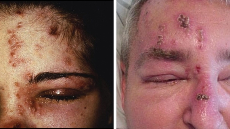 Tổn thương mắt nghiêm trọng do biến chứng của zona