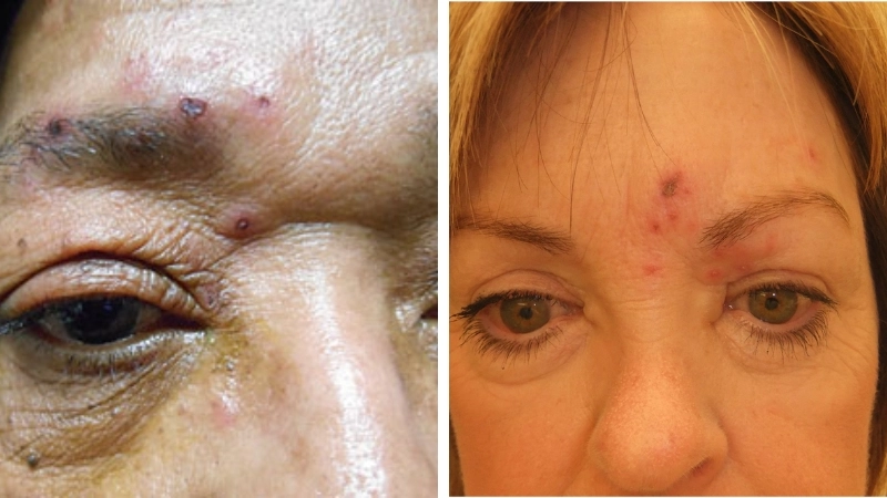 Hình ảnh thuốc nhỏ mắt trị zona chuyên dụng