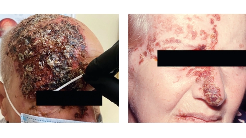 Minh họa bệnh zona ở mắt kiêng ăn gì để nhanh hồi phục