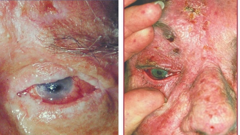 Bệnh zona ở mắt bao lâu thì khỏi khi can thiệp sớm