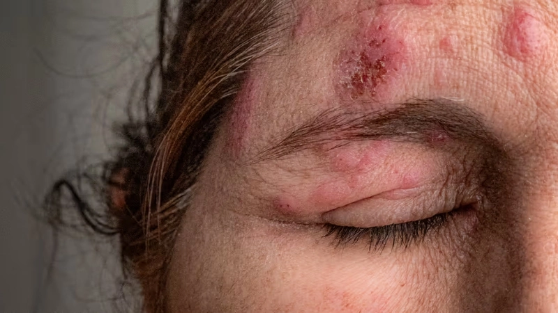 Bệnh zona ở mắt bao lâu thì khỏi khi can thiệp sớm