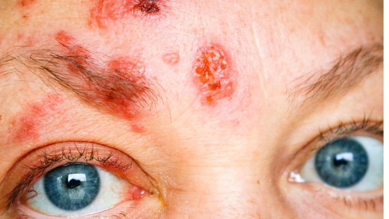 Cách điều trị zona ở mắt theo phác đồ y khoa