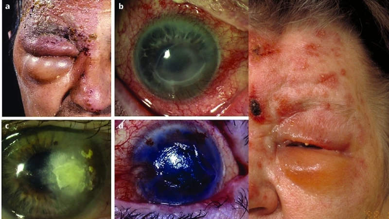 Zona ở mắt có nguy hiểm không thể hiện qua tổn thương mí mắt