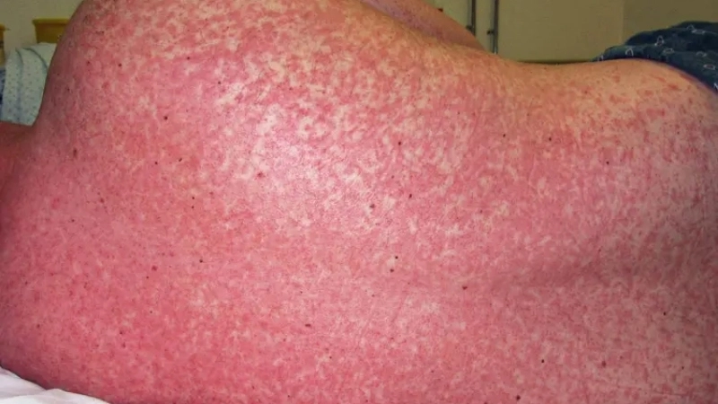 Hình ảnh bệnh sởi ở trẻ sơ sinh cần chú ý