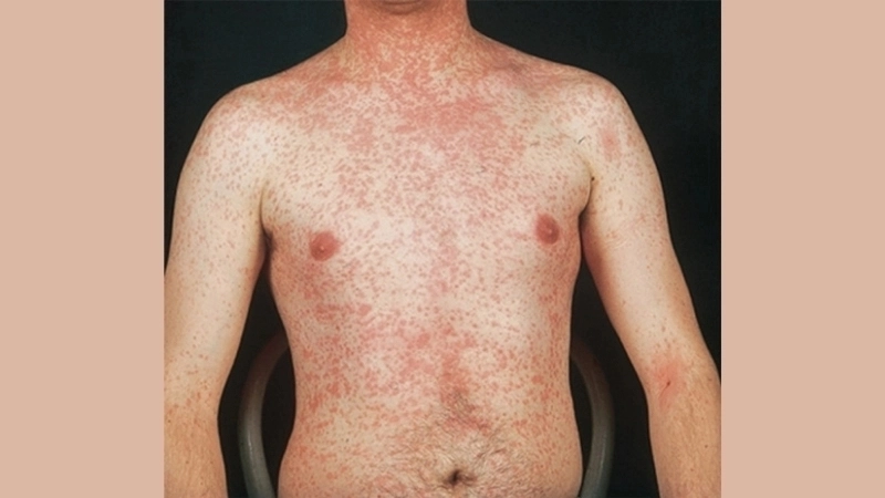 Hình ảnh trẻ bị sởi với nốt ban đỏ